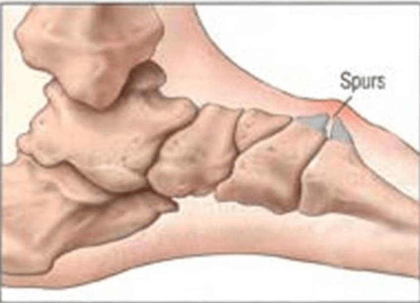 Bony growth top deals of foot